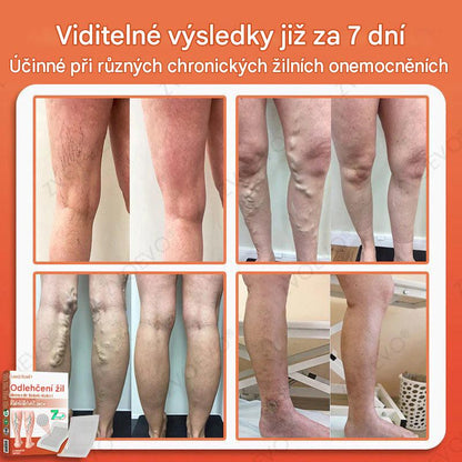 ☘️ Zvoevo® Vein Ease mikrojehličkové náplasti (pro zlepšení stavu pavoučích žil, křečových žil a otoků a únavy nohou)