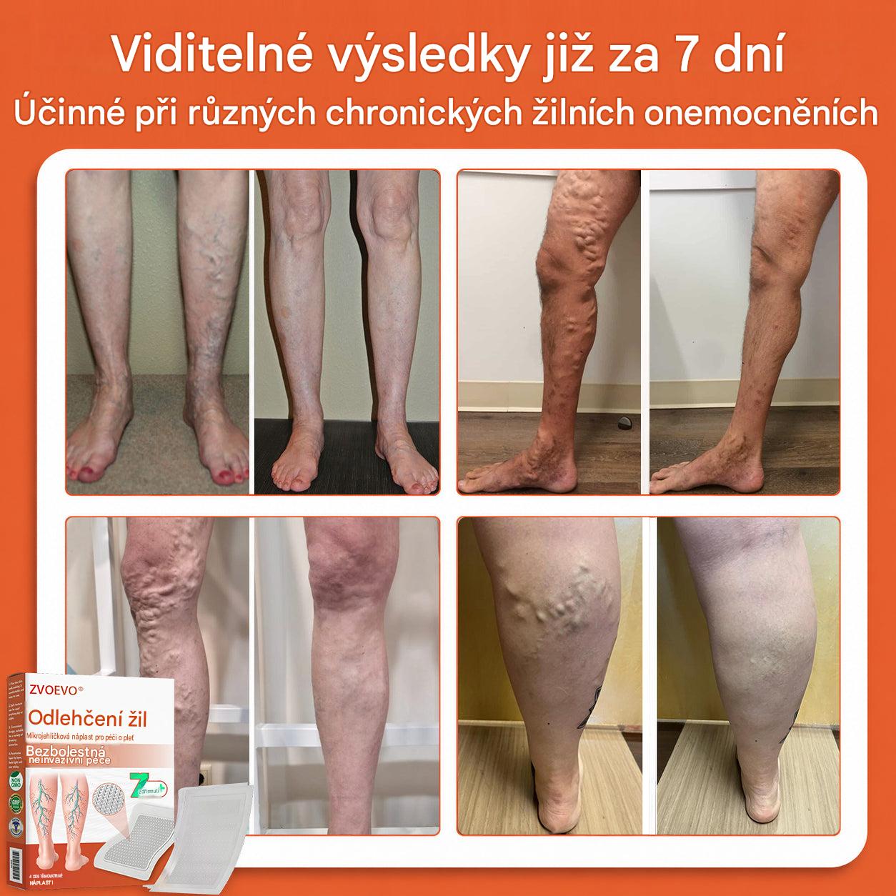 ☘️ Zvoevo® Vein Ease mikrojehličkové náplasti (pro zlepšení stavu pavoučích žil, křečových žil a otoků a únavy nohou)