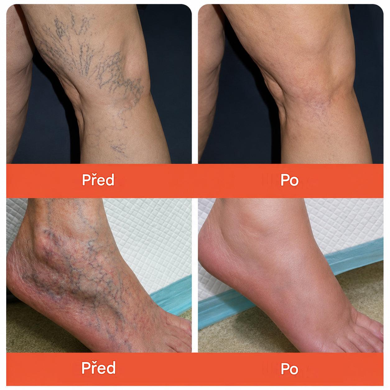 ☘️ Zvoevo® Vein Ease mikrojehličkové náplasti (pro zlepšení stavu pavoučích žil, křečových žil a otoků a únavy nohou)