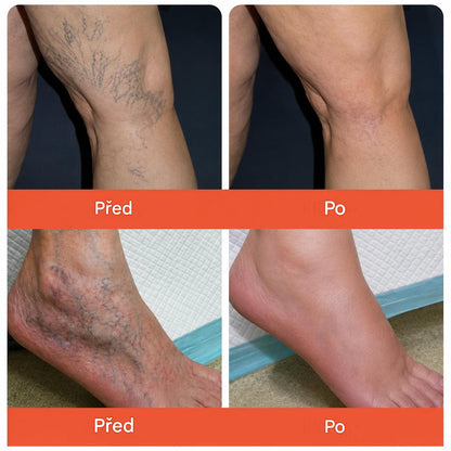 ☘️ Zvoevo® Vein Ease mikrojehličkové náplasti (pro zlepšení stavu pavoučích žil, křečových žil a otoků a únavy nohou)