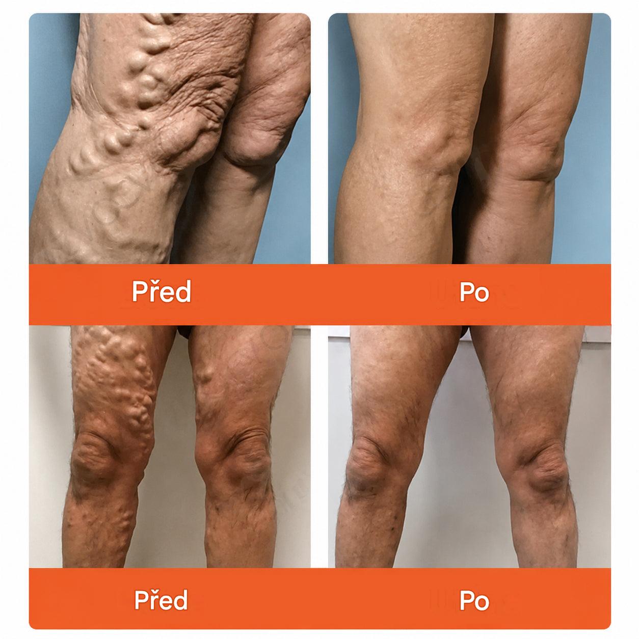 ☘️ Zvoevo® Vein Ease mikrojehličkové náplasti (pro zlepšení stavu pavoučích žil, křečových žil a otoků a únavy nohou)