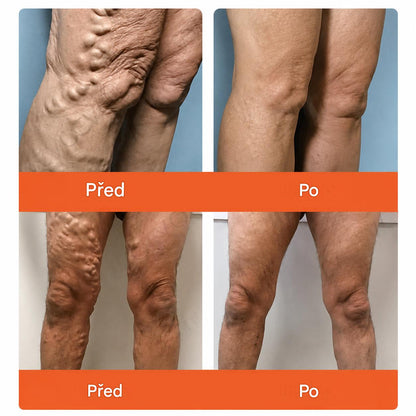 ☘️ Zvoevo® Vein Ease mikrojehličkové náplasti (pro zlepšení stavu pavoučích žil, křečových žil a otoků a únavy nohou)