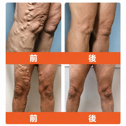 ☘️【厚生労働省認可・GMP準拠】Zvoevo® Vein Ease マイクロニードルケアパッチ（クモ状静脈・静脈瘤・むくみ・脚の疲れに）⭐️